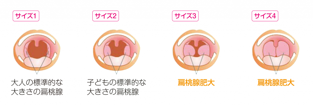 扁桃腺の肥大