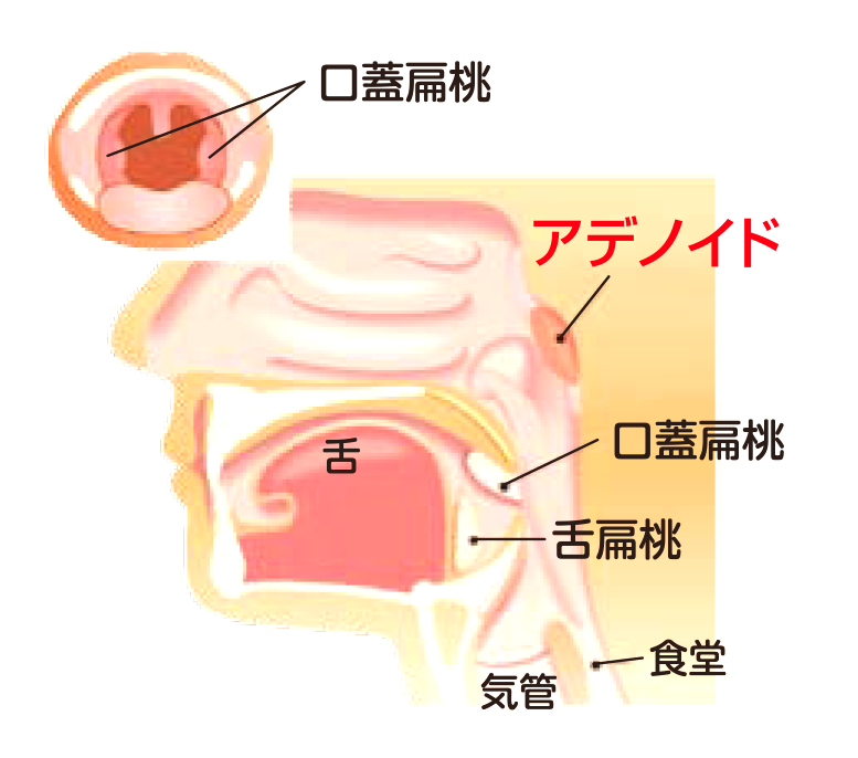 アデノイド