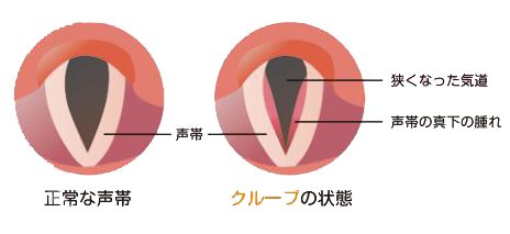 クループ(声門下喉頭炎)